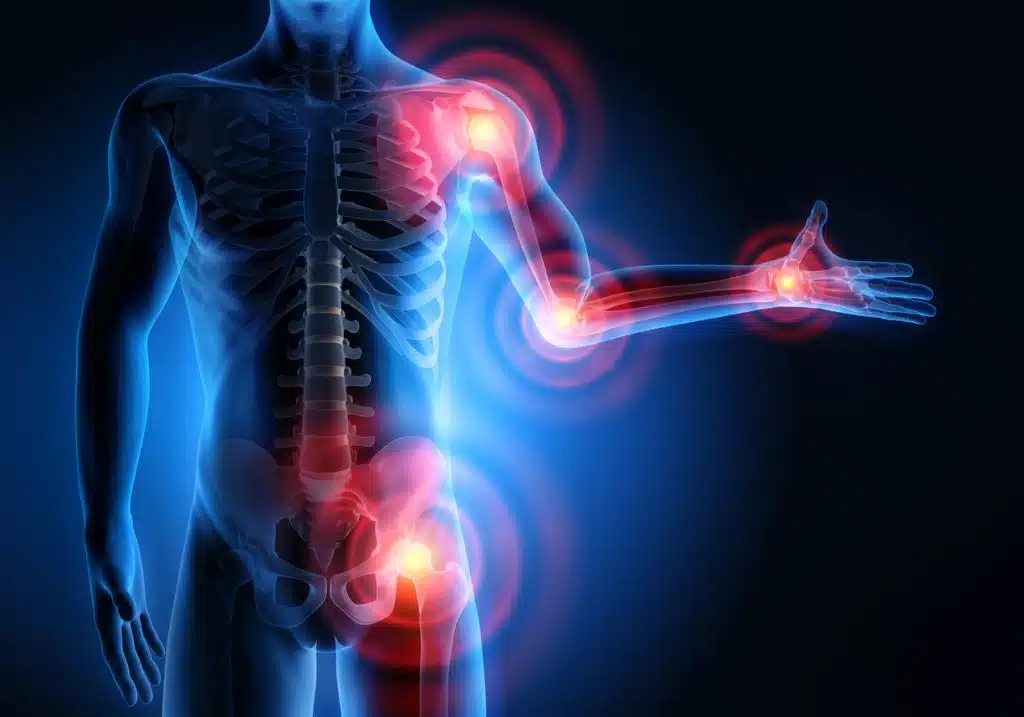 Can Chiropractic Help Arthritis